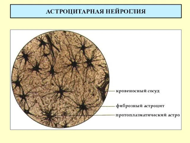 АСТРОЦИТАРНАЯ НЕЙРОГЛИЯ