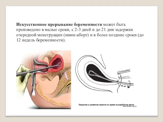 Искусственное прерывание беременности может быть произведено в малые сроки, с 2-3