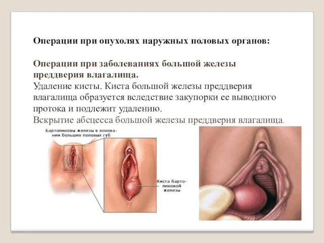 Операции при опухолях наружных половых органов: Операции при заболеваниях большой железы