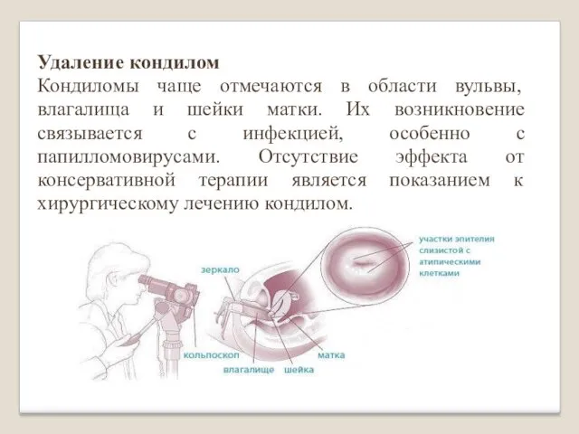 Удаление кондилом Кондиломы чаще отмечаются в области вульвы, влагалища и шейки