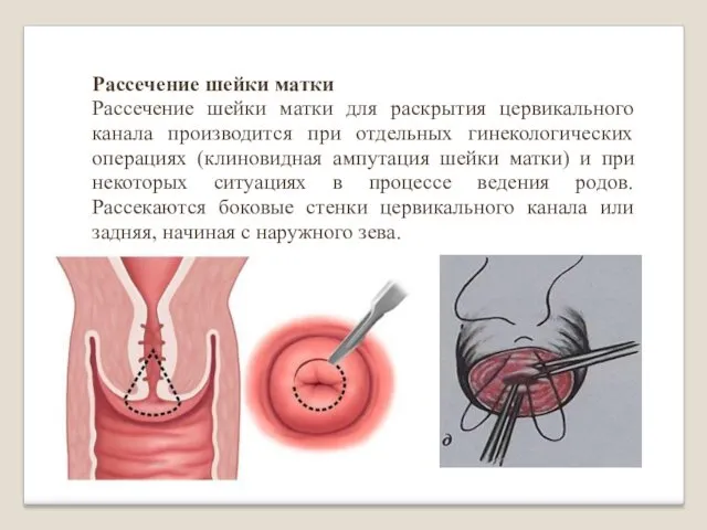 Рассечение шейки матки Рассечение шейки матки для раскрытия цервикального канала производится