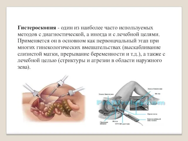 Гистероскопия - один из наиболее часто используемых методов с диагностической, а