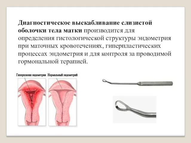 Диагностическое выскабливание слизистой оболочки тела матки производится для определения гистологической структуры
