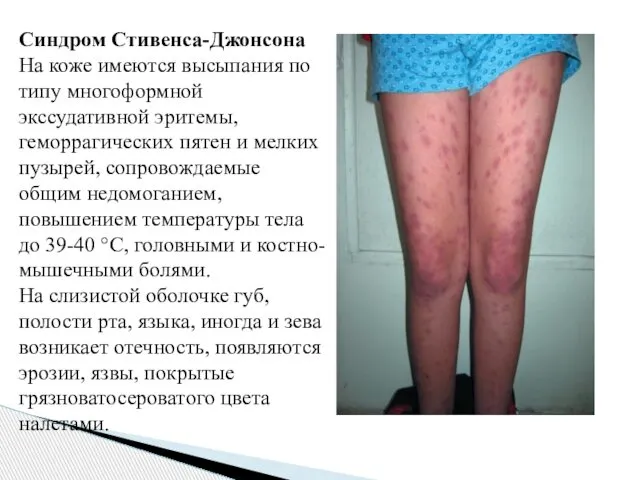 Синдром Стивенса-Джонсона На коже имеются высыпания по типу многоформной экссудативной эритемы,