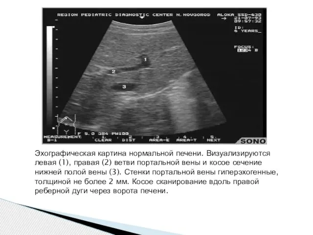 Эхографическая картина нормальной печени. Визуализируются левая (1), правая (2) ветви портальной