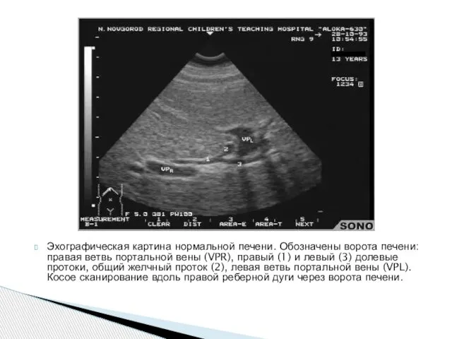 Эхографическая картина нормальной печени. Обозначены ворота печени: правая ветвь портальной вены