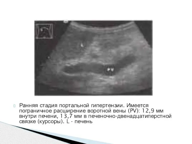 Ранняя стадия портальной гипертензии. Имеется пограничное расширение воротной вены (PV): 12,9