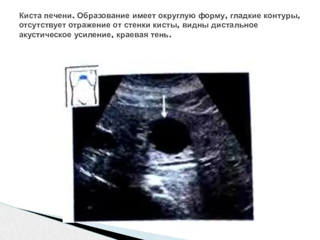 Киста печени. Образование имеет округлую форму, гладкие контуры, отсутствует отражение от