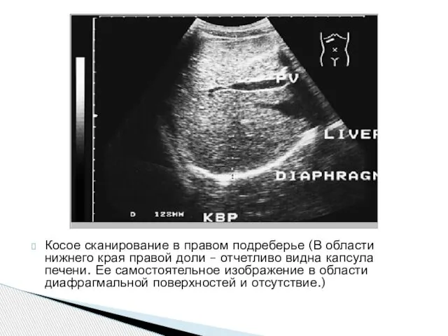 Косое сканирование в правом подреберье (В области нижнего края правой доли