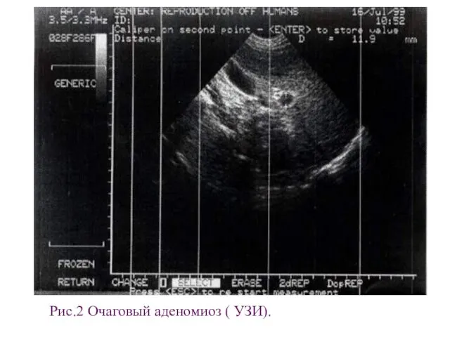 Рис.2 Очаговый аденомиоз ( УЗИ).