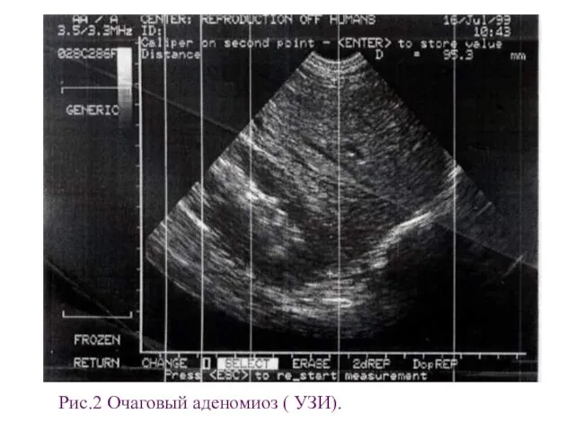Рис.2 Очаговый аденомиоз ( УЗИ).