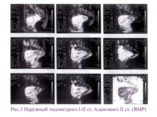 Рис.3 Наружный эндометриоз I-II ст. Аденомиоз II ст. (ЯМР)