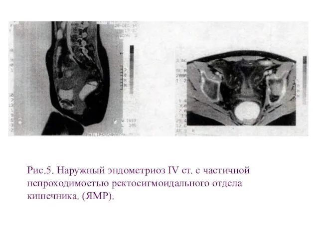 Рис.5. Наружный эндометриоз IV ст. с частичной непроходимостью ректосигмоидального отдела кишечника. (ЯМР).