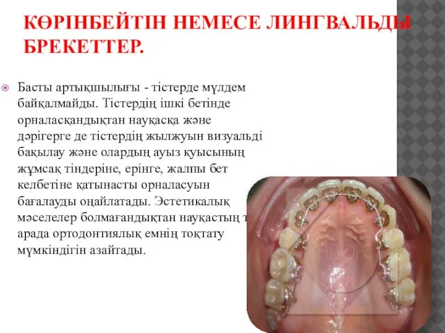 КӨРІНБЕЙТІН НЕМЕСЕ ЛИНГВАЛЬДЫ БРЕКЕТТЕР. Басты артықшылығы - тістерде мүлдем байқалмайды. Тістердің