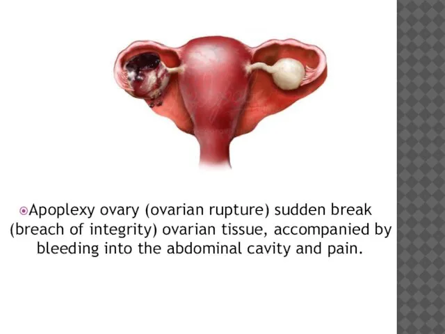 Apoplexy ovary (ovarian rupture) sudden break (breach of integrity) ovarian tissue,