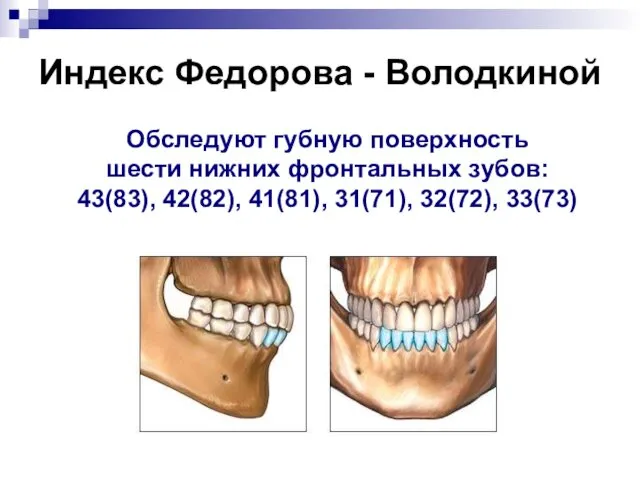 Индекс Федорова - Володкиной Обследуют губную поверхность шести нижних фронтальных зубов: