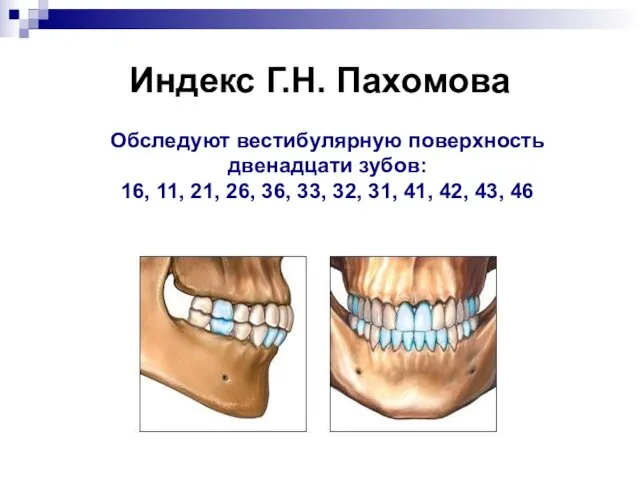 Индекс Г.Н. Пахомова Обследуют вестибулярную поверхность двенадцати зубов: 16, 11, 21,