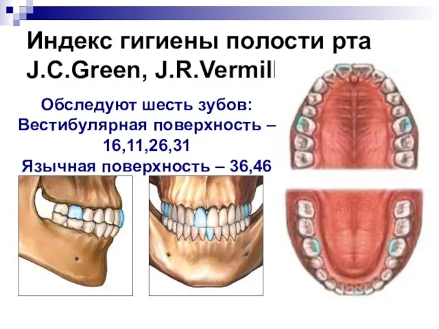 Индекс гигиены полости рта J.C.Green, J.R.Vermillion Обследуют шесть зубов: Вестибулярная поверхность