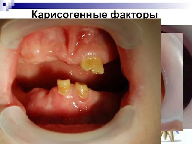 Карисогенные факторы общие местные Диета Сопутствующие болезни Экстремальные воздействия Бактерии зубного