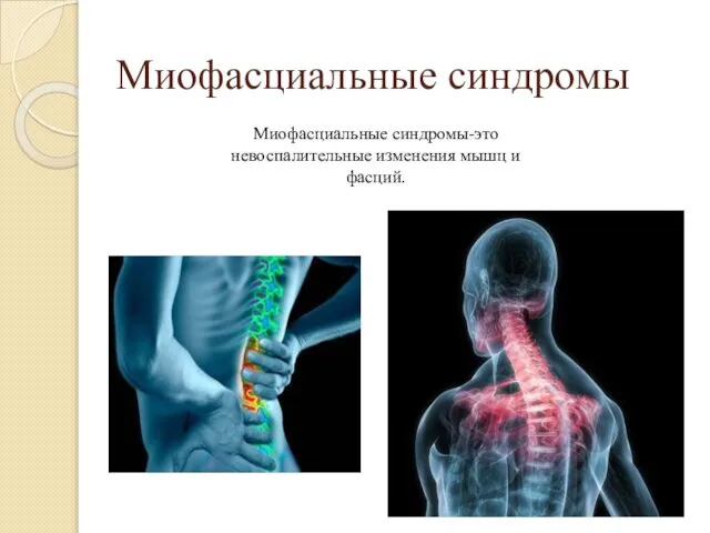 Миофасциальные синдромы Миофасциальные синдромы-это невоспалительные изменения мышц и фасций.