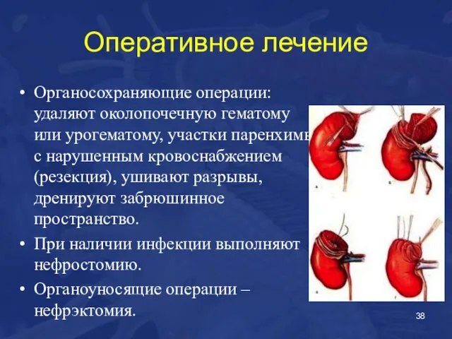 Оперативное лечение Органосохраняющие операции: удаляют околопочечную гематому или урогематому, участки паренхимы