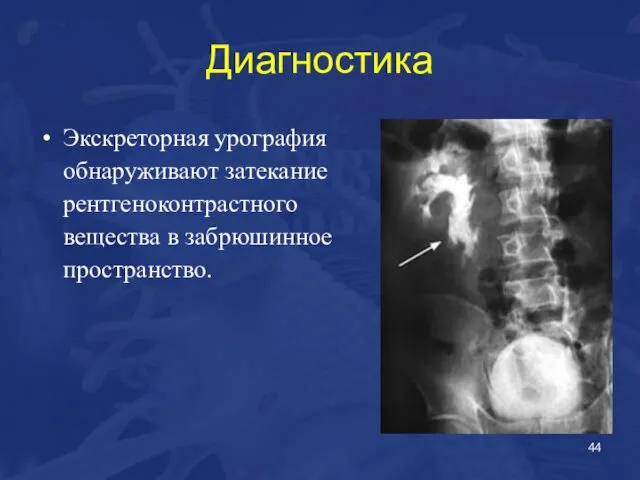 Диагностика Экскреторная урография обнаруживают затекание рентгеноконтрастного вещества в забрюшинное пространство.