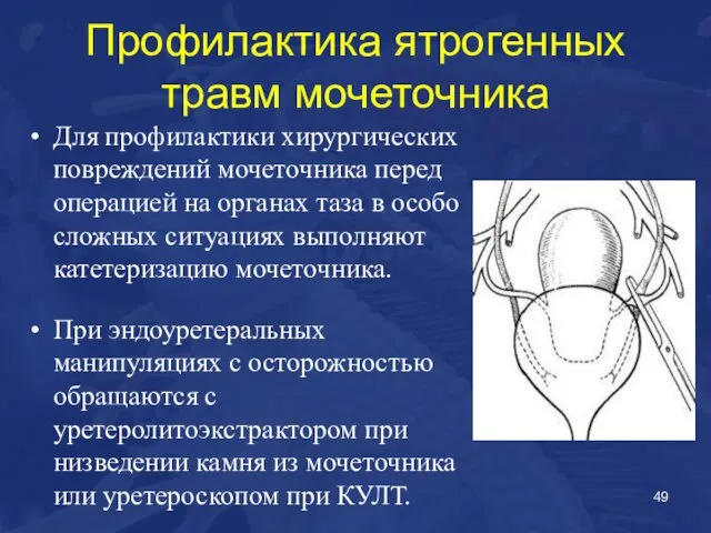 Профилактика ятрогенных травм мочеточника Для профилактики хирургических повреждений мочеточника перед операцией