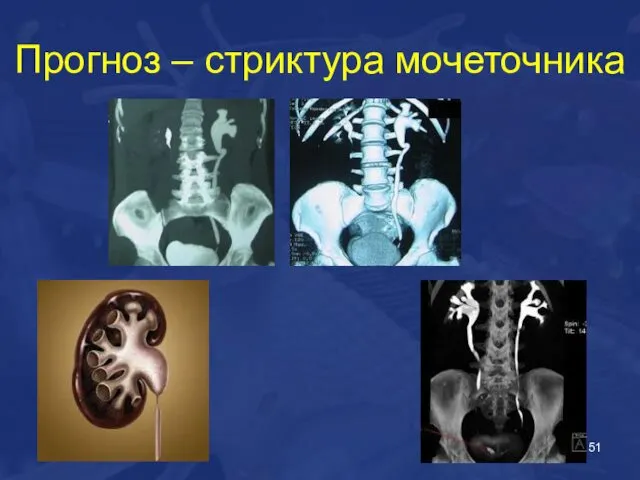 Прогноз – стриктура мочеточника