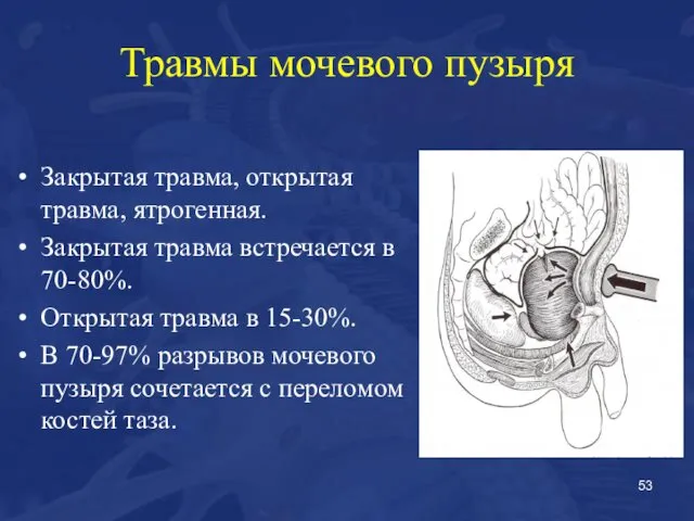 Травмы мочевого пузыря Закрытая травма, открытая травма, ятрогенная. Закрытая травма встречается