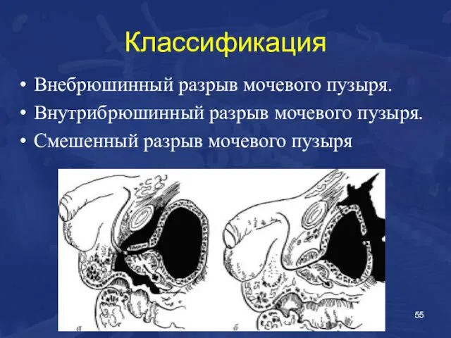 Классификация Внебрюшинный разрыв мочевого пузыря. Внутрибрюшинный разрыв мочевого пузыря. Смешенный разрыв мочевого пузыря