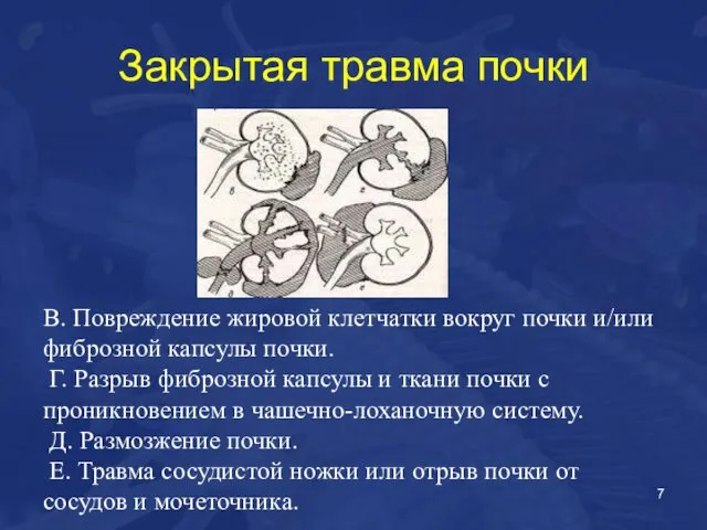 Закрытая травма почки В. Повреждение жировой клетчатки вокруг почки и/или фиброзной