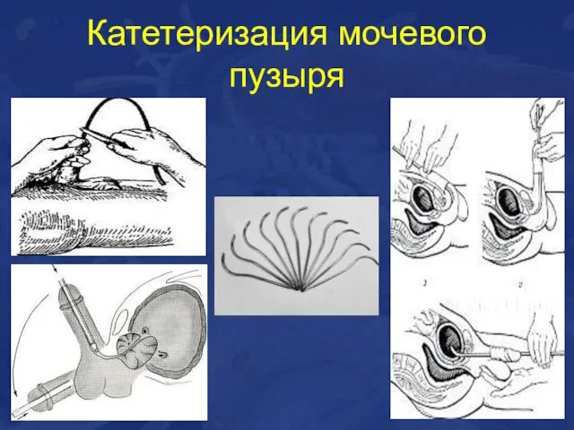 Катетеризация мочевого пузыря