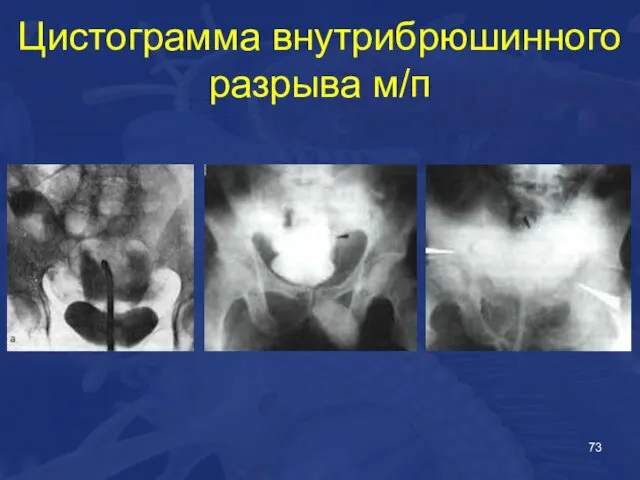 Цистограмма внутрибрюшинного разрыва м/п