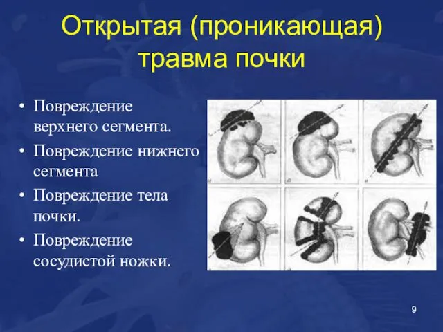 Открытая (проникающая) травма почки Повреждение верхнего сегмента. Повреждение нижнего сегмента Повреждение тела почки. Повреждение сосудистой ножки.