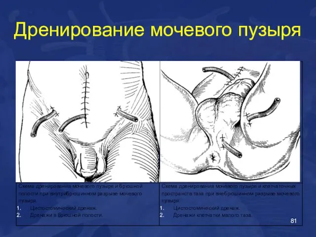 Дренирование мочевого пузыря