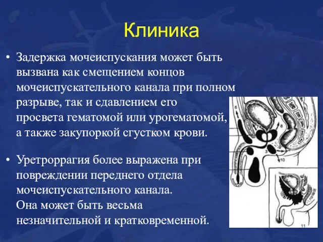 Клиника Задержка мочеиспускания может быть вызвана как смещением концов мочеиспускательного канала