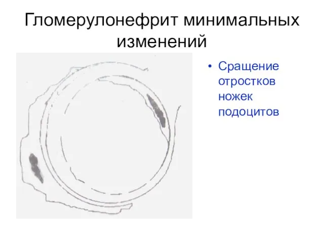 Гломерулонефрит минимальных изменений Сращение отростков ножек подоцитов