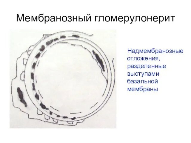 Мембранозный гломерулонерит Надмембранозные отложения, разделенные выступами базальной мембраны