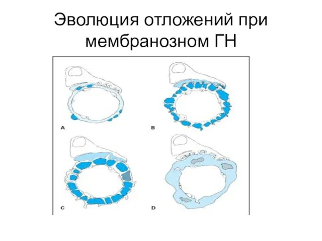 Эволюция отложений при мембранозном ГН