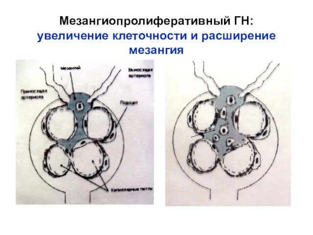 Мезангиопролиферативный ГН: увеличение клеточности и расширение мезангия