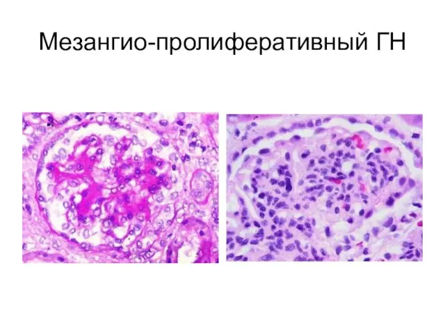 Мезангио-пролиферативный ГН