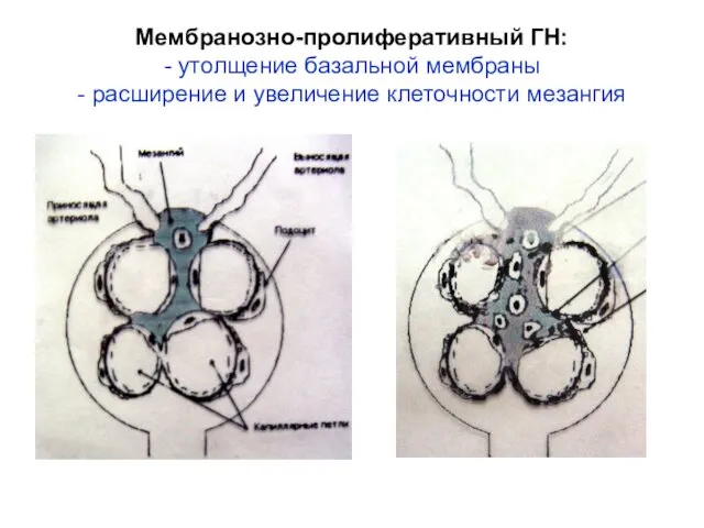 Мембранозно-пролиферативный ГН: - утолщение базальной мембраны - расширение и увеличение клеточности мезангия