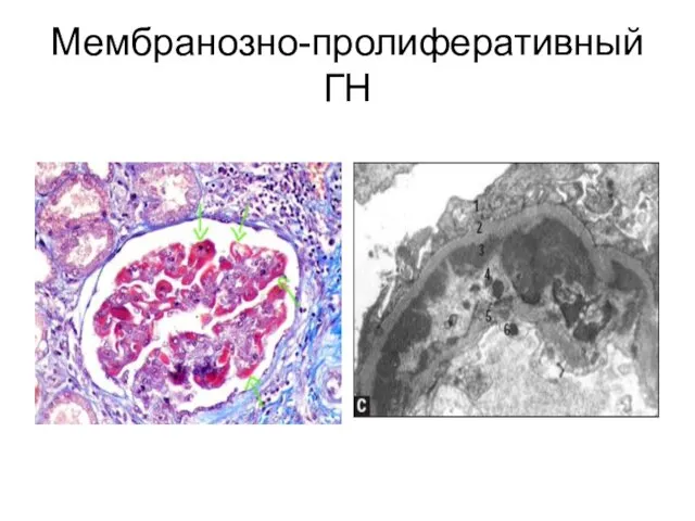 Мембранозно-пролиферативный ГН