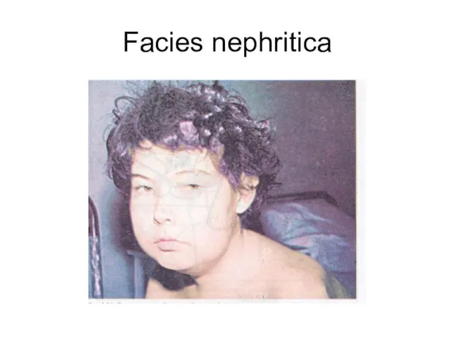 Facies nephritica