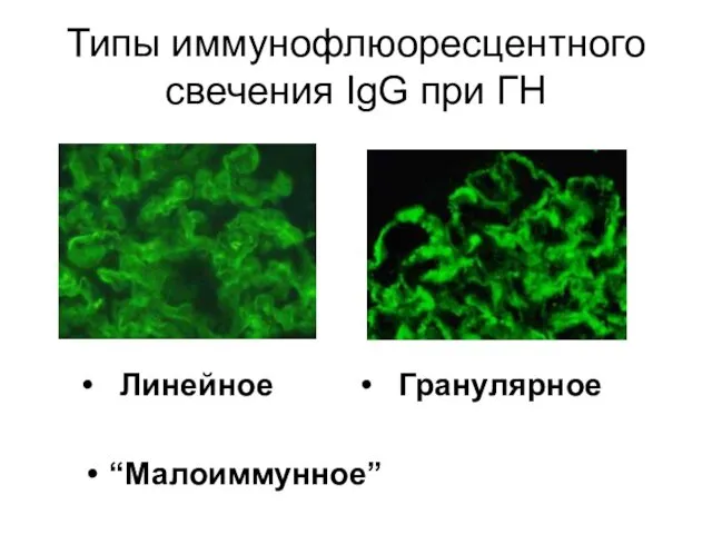 Типы иммунофлюоресцентного свечения IgG при ГН • Линейное • Гранулярное “Малоиммунное”