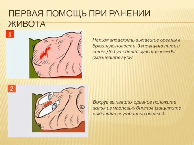 ПЕРВАЯ ПОМОЩЬ ПРИ РАНЕНИИ ЖИВОТА Нельзя вправлять выпавшие органы в брюшную