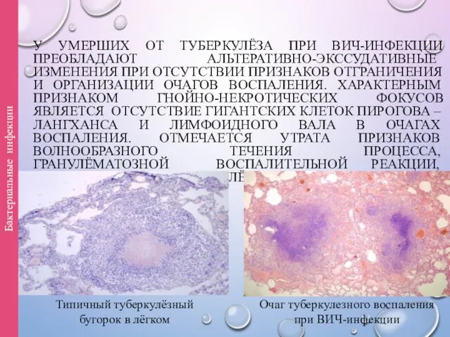 У УМЕРШИХ ОТ ТУБЕРКУЛЁЗА ПРИ ВИЧ-ИНФЕКЦИИ ПРЕОБЛАДАЮТ АЛЬТЕРАТИВНО-ЭКССУДАТИВНЫЕ ИЗМЕНЕНИЯ ПРИ ОТСУТСТВИИ