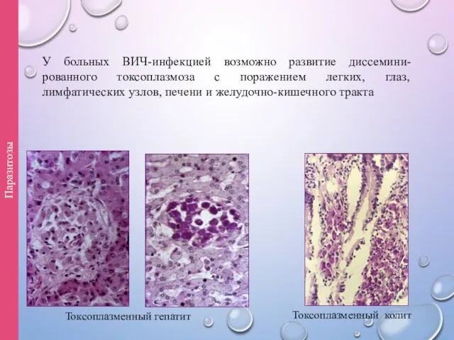 Токсоплазменный гепатит Токсоплазменный колит Паразитозы У больных ВИЧ-инфекцией возможно развитие диссемини-рованного