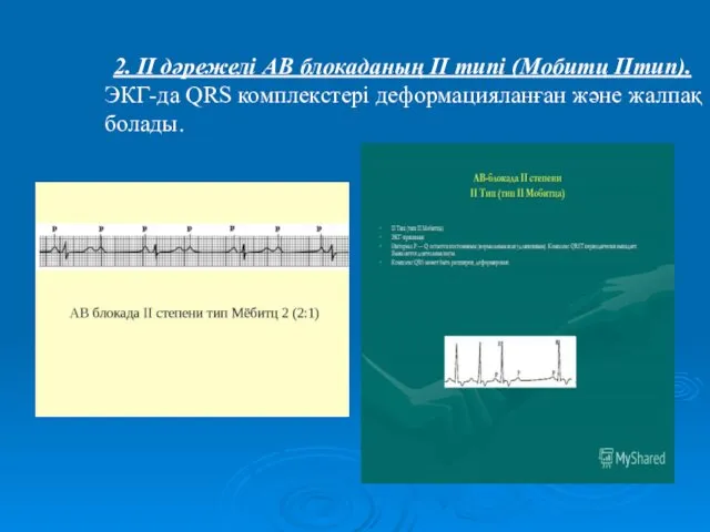 2. ІІ дәрежелі АВ блокаданың ІІ типі (Мобитц ІІтип). ЭКГ-да QRS комплекстері деформацияланған және жалпақ болады.