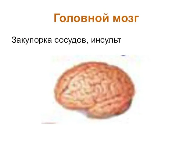 Головной мозг Закупорка сосудов, инсульт